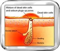 How acne starts.